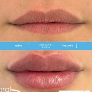 aumento labios antes despues 2