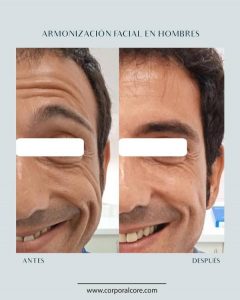 tratamiento neuromoduladores 3