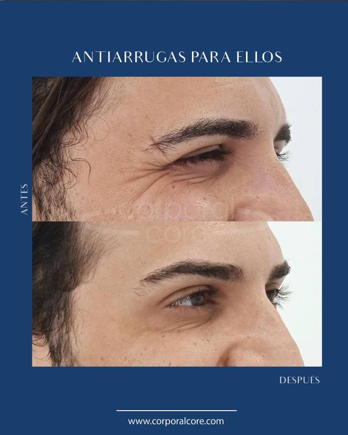 tratamiento neuromoduladores 4