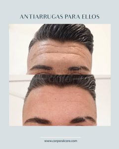 tratamiento neuromoduladores 6