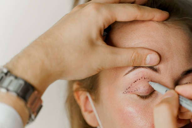 blefaroplastia precios